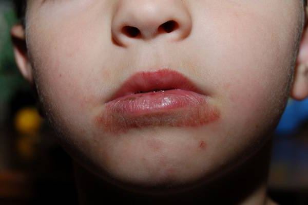 Обривът в устата на детето: какви заболявания го причиняват?